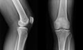 X-ray knee radiograph Royalty Free Stock Photo