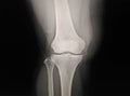 X-ray Knee ap normal radiography of the knee joint, medical diagnostics, traumatology and orthopedics Royalty Free Stock Photo