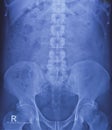 X-ray of KUB region. Bowel gas and fecal matter. Normal finding