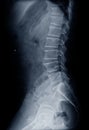 x-ray L-S spine lateral views showing Compression fracture L1 vertebral body. Medical image concept