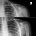 X-ray of the left collarbone. Fracture of clavicle. Consolidation of the fracture. Royalty Free Stock Photo