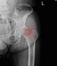 X-ray left hip : fracture left Neck of femur