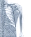 X-ray image of humerus bone.