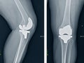 X-ray of the left knee joint. Condition after total endoprosthetics