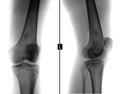 X-ray of the left knee joint. Ewing sarcoma, lymphoma, myeloma thigh bone. Negative.