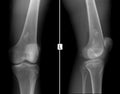 X-ray of the left knee joint. Ewing sarcoma, lymphoma, myeloma thigh bone.