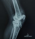 X-ray Left Knee Lateral view. Avulsion fracture tibial tubercle, Medical image concept.