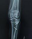 X-ray Left Knee Lateral view. Avulsion fracture tibial tubercle, post - fixation.