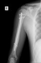 X-ray of the left shoulder. Fracture of the shoulder with metal. Royalty Free Stock Photo