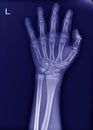 X-ray left wrist No fracture and normal joint Royalty Free Stock Photo