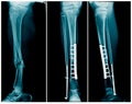 Fracture leg both bone with post operation fixation Royalty Free Stock Photo