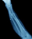 X-ray of leg