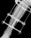 X-ray of leg with fixation Royalty Free Stock Photo