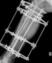 X-ray of leg with fixation Royalty Free Stock Photo