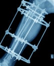 X-ray of leg with fixation Royalty Free Stock Photo