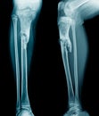 Osteomyelitis tibia Royalty Free Stock Photo