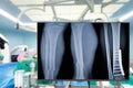 X-ray of legs. Blurry Traumatology orthopedic surgery hospital operating room for the legs operation. Medical health and Education