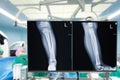 X-ray of legs. Blurry Traumatology orthopedic surgery hospital operating room for the legs operation. Medical health and Education