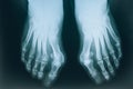 X-ray of the legs. Two feet, X-ray direct projection Royalty Free Stock Photo