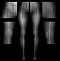 X-ray for length measurement on both legs Royalty Free Stock Photo