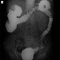 X-ray of the lower parts of the gastrointestinal tract GI. Tight filling. Dolichocolon. Diverticulosis.