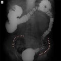 X-ray of the lower parts of the gastrointestinal tract GI. Tight filling. Dolichocolon. Diverticulosis. Marker.