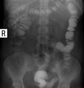 X-ray of the lower parts of the gastrointestinal tract GI. Tight filling. Dolihosigma, diverticulosis.