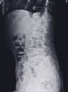 X-ray lumbar spine finding Multiple hyperdensity and hypodensity bone lesions at both iliac bones Royalty Free Stock Photo