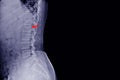 X-ray lumbar spine fracture L1 on red point Royalty Free Stock Photo