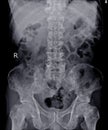 X-ray Lumbar spine impression: Multiple bone metastasis