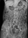 X-ray of lumbar spine the study reveals burst fracture of L2 vertebral body