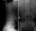 X-ray of the lumbar spine. Wedge-shaped deformed body of the vertebra.