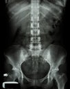 X-ray lumbo-sacral spine and pelvis of asian adult people Royalty Free Stock Photo