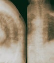 X-ray lumbo-sacral spine and pelvis. Examination scan