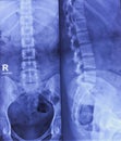 X-ray of Lumbosacral spine both view. Muscle spasm, Straightining of lumber lordotic curvature