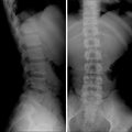 X-ray of Lumbosacral spine, Frontal Sagital view scoliosis