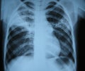 X-ray/lung Royalty Free Stock Photo