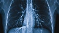 X-ray of a lung with pneumonia and pleural effusion