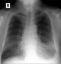 X-ray lung. showing a large infiltrate in the left lung, Pleurisy. Pneumonia.