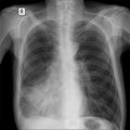 X-ray lung. showing a large infiltrate in the middle lobe of the right lung. Pneumonia.