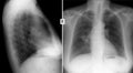 X-ray of the lungs. Central cancer of the right lung.