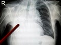 X-ray of the lungs Royalty Free Stock Photo