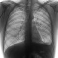 X-ray of the lungs: Hemothorax, rib fractures of the left. Negative. Royalty Free Stock Photo