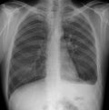 X-ray of the lungs: Hemothorax, rib fractures of the left.