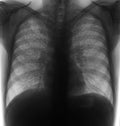 X-ray of the lungs. Miliary tuberculosis. Negative.