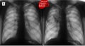 X-ray of the lungs: Operated lung. Escalation tuberculosis of the lungs after 6 months. Negative. Royalty Free Stock Photo