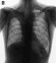 X-ray of the lungs: Postradiation pneumofibrosis. Negative.