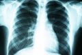 X-ray of the lungs, radiological examination of chest diseases