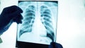 X-ray of the lungs to look at the light,the doctor is carefully examining the diagnosis,close-up