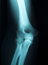 X-ray of a male arm Royalty Free Stock Photo